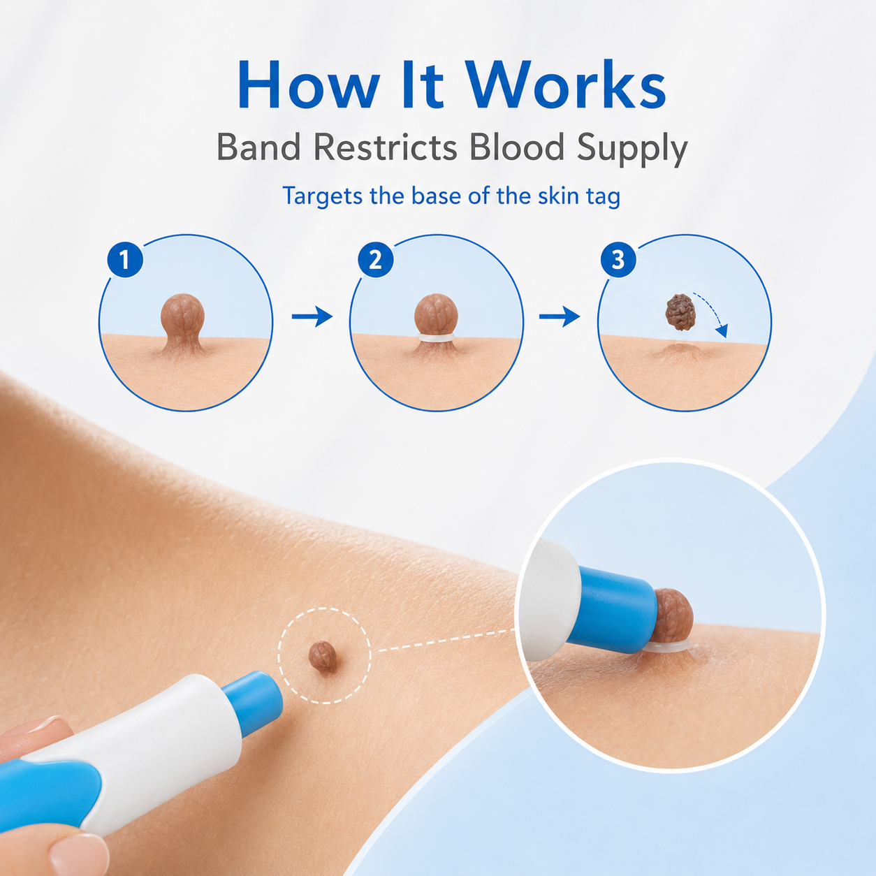 🩹 Skin Tag Removal Kit – 2-in-1 Auto Band Applicator with Dual Size Options for At-Home Use