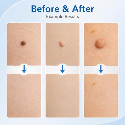 🩹 Skin Tag Removal Kit – 2-in-1 Auto Band Applicator with Dual Size Options for At-Home Use