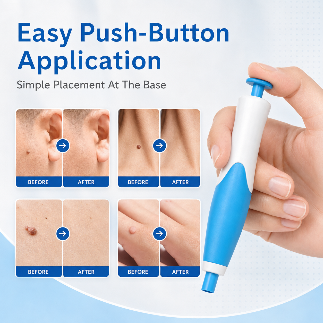 🩹 Skin Tag Removal Kit – 2-in-1 Auto Band Applicator with Dual Size Options for At-Home Use